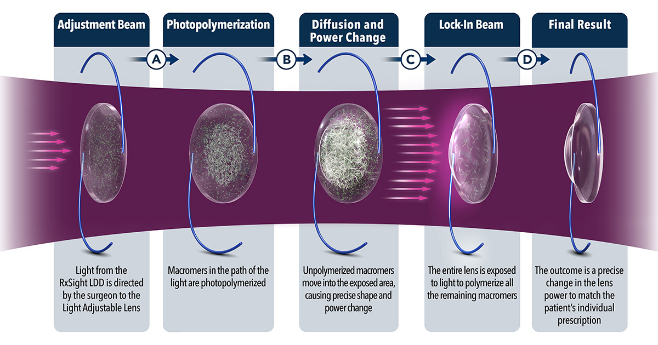 Illustration of step-by-step process showing how the Light Adjustable Lens is adjusted to match vision needs.