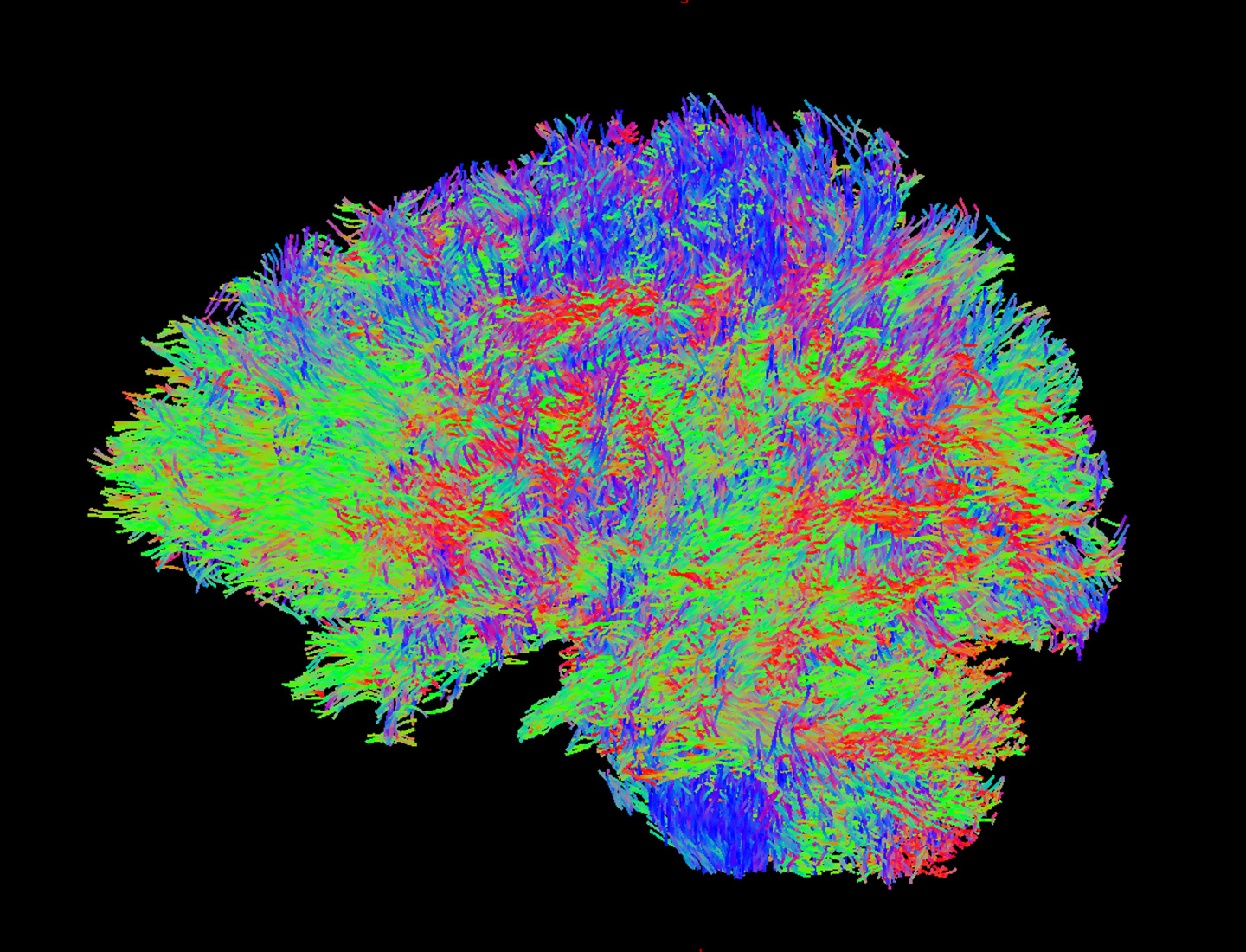 Color-coded brain scan showing neural pathways using diffusion tensor imaging tractography.
