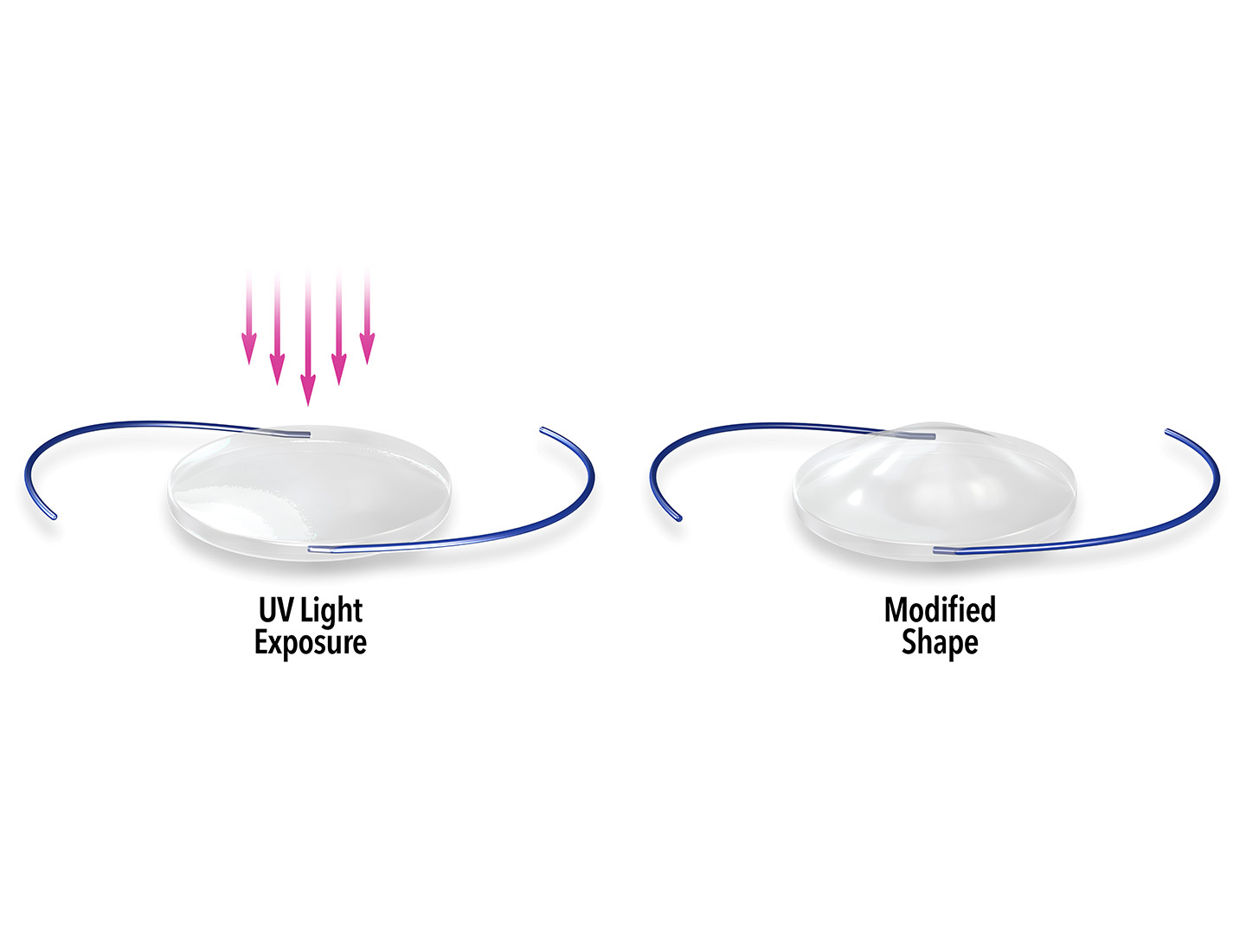 Light Adjustable Lens shown before and after UV light exposure, changing shape to improve vision.