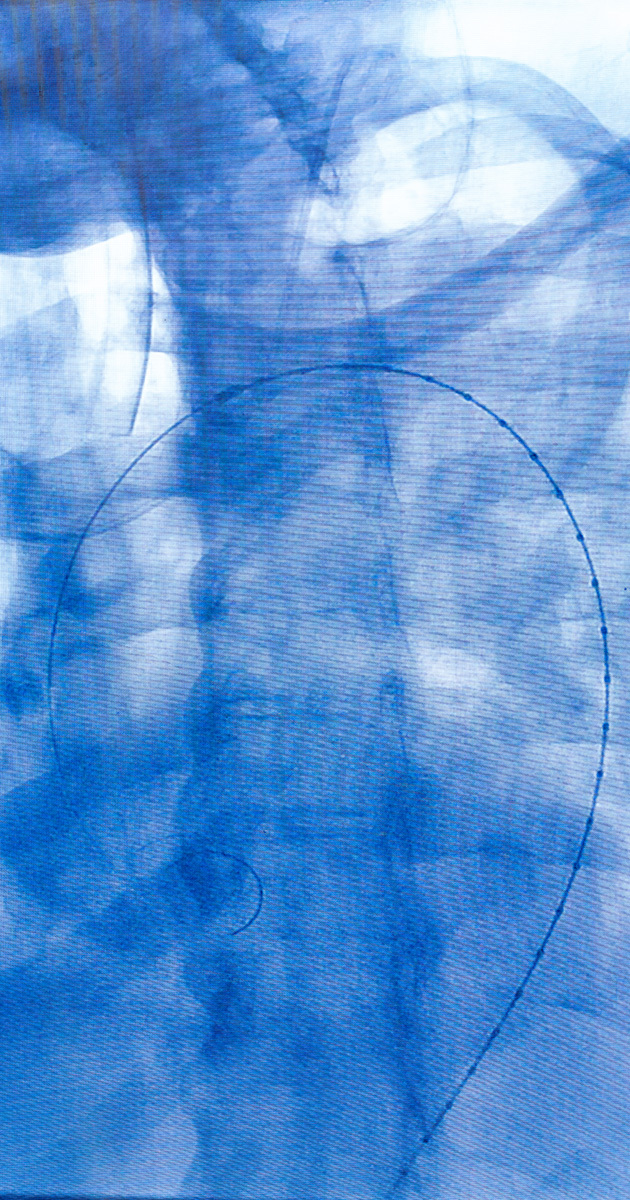 Fluoroscopic chest scan showing a guidewire positioned in the heart or blood vessels.